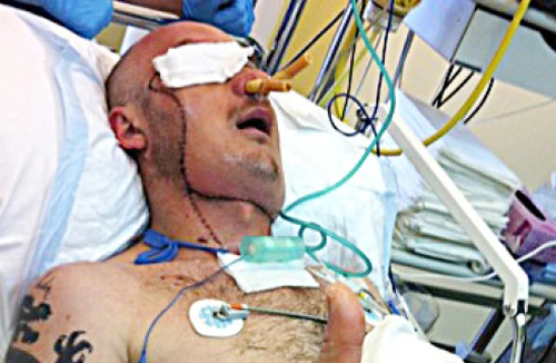 Kỳ diệu: Người đầu tiên được cứu sống nhờ ghép mặt