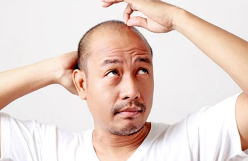 Hói đầu làm tăng nguy cơ bệnh thần kinh nghiêm trọng