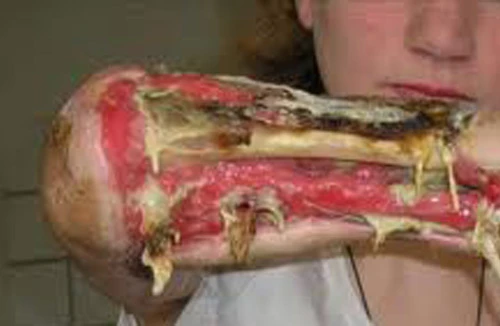 Khủng khiếp ma túy tự chế “cá sấu”: Rẻ, "phê" nhưng cực độc