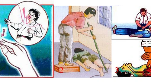 Cấp cứu nạn nhân bị điện giật