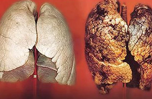 Phương pháp mới điều trị ung thư phổi 