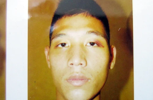 Tên trộm vờ bị chấn thương sọ não