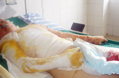 Người yêu không chịu cưới, tẩm xăng đốt cả đôi