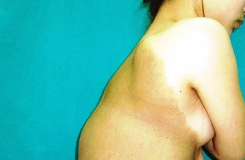 Cắt bỏ khối u nặng 7kg trên lưng nữ bệnh nhân