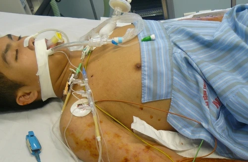 Vi khuẩn “ăn thịt người” xuất hiện ở Việt Nam từ năm 2009