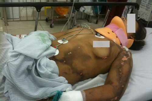 Hà Nội: Đang cấy lúa, một phụ nữ bị sét đánh bất tỉnh