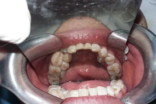 Hy hữu: Nam thanh niên mọc thừa… 17 cái răng