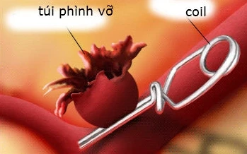 Cứu sống bé 11 tuổi bị vỡ túi phình mạch máu não 