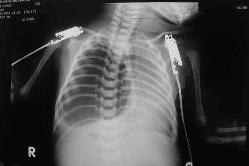 Bé mới sinh nguy hiểm vì kén khí to trong phổi