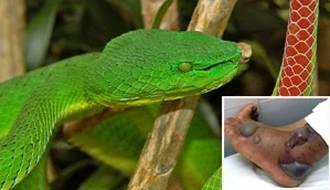 Bị rắn lục rắn, bé 9 tuổi bị rối loạn đông máu toàn thân