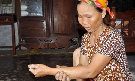 Xanh mặt chuyện một phụ nữ “đẻ” ra đỉa dài 30cm, to bằng cổ tay