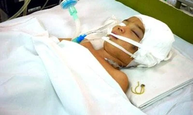 Chấn thương sọ não ở trẻ nhỏ - Hiểm họa khôn lường