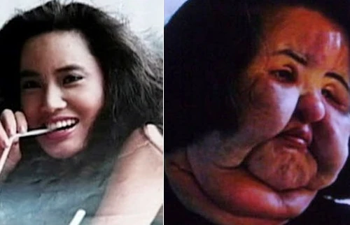 Những thảm họa kinh hoàng từ phẫu thuật thẩm mỹ