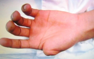 Giận vợ, tự mình chặt đứt bàn tay rồi đem luộc