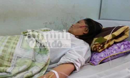 Bố chồng ẩu đả, chém biến dạng mặt nàng dâu 