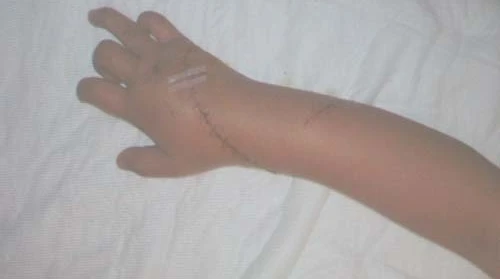 Một phụ nữ bị chém đứt gân tay vì chưa trả hết tiền nợ