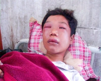 Ông ngoại đánh cháu dã man vì mất chiếc Huân chương