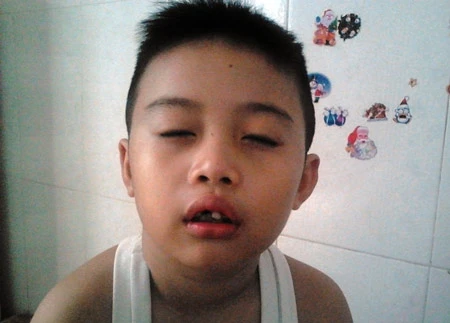 Rối mù vụ cô giáo "lỡ tay" làm gãy răng, giập miệng học sinh