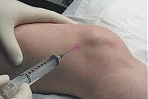 Arthri-Flex: Sản phẩm có thành phần Acid Hyaluronic với hàm lượng cao nhất