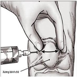 Tiêm thuốc thoái hóa khớp (Axit hyaluronic) liệu có mang lại hiệu quả?