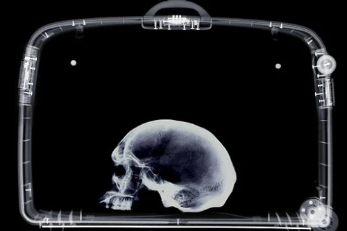 Bị bắt vì mang sọ người trong vali