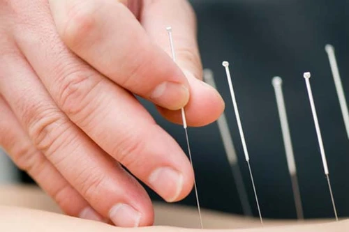 Châm cứu giúp giảm mức độ stress