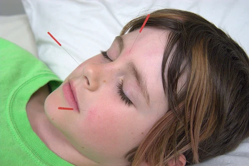 Châm cứu an toàn cho trẻ