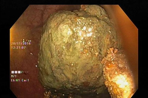 Kỳ lạ nữ bệnh nhân có 4 khối bã thức ăn to như quả trứng trong dạ dày