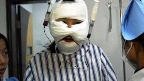 Cụ ông cuồng ghen cắt mũi, tai, môi người tình ném xuống toilet