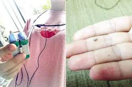 Thi THPT quốc gia: "Tuyệt chiêu" gian lận sử dụng tai nghe siêu nhỏ bằng hạt đậu