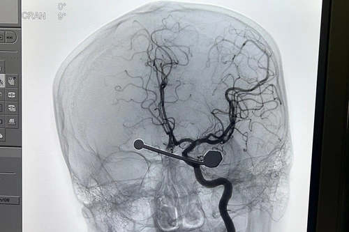 Cứu sống nam thanh niên bị thanh sắt cắm sâu vào mắt do tai nạn xe máy