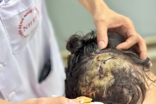 Bé gái 5 tuổi ở Hà Nội nhập viện với hơn 10 vết thương do chó cắn