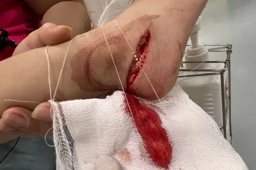 Bé trai 3 tuổi ở Hà Nội đứt gân chân do dẫm phải dao gọt hoa quả vứt trên nền nhà