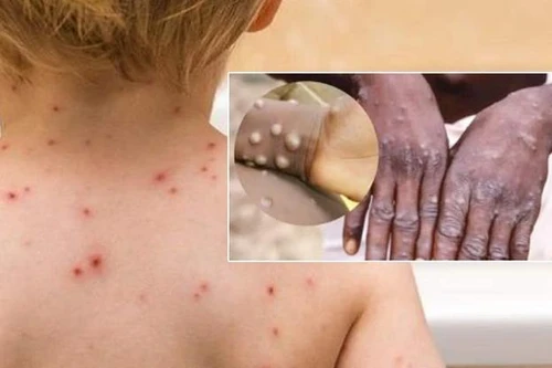 Bộ Y tế họp khẩn cùng WHO: Việt Nam chưa có ca bệnh đậu mùa khỉ nhưng nguy cơ rất lớn