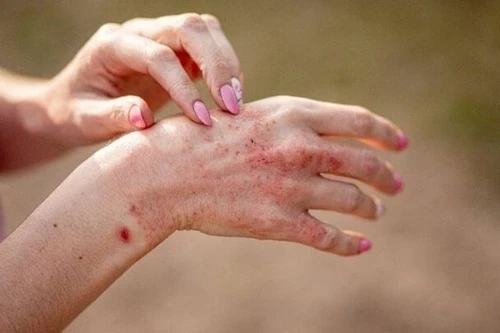 Bộ Y tế khuyến cáo chi tiết cách phòng, chống các bệnh thường gặp sau mưa bão, ngập lụt