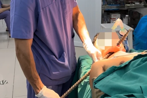 Người đàn ông được đưa vào viện với thanh xà beng dài gần 1m đâm xuyên vùng cổ