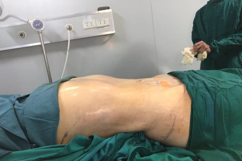 Một phụ nữ bị hoại tử nghiêm trọng do hút mỡ bụng, cắt sẹo ở spa