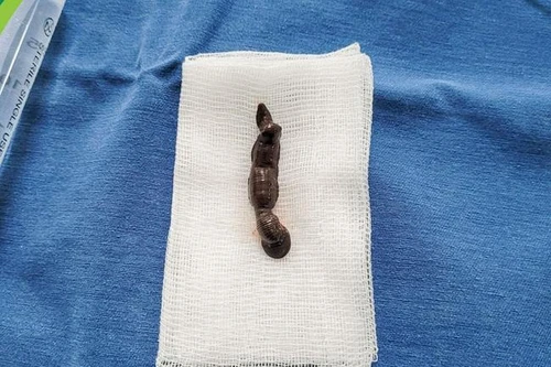 Gắp con đỉa sống gần một tháng trong khí quản bé trai 4 tuổi