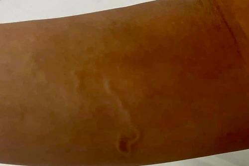 Ăn gỏi cá, nam thanh niên nhiễm giun, ký sinh trùng bò lổn nhổn dưới da