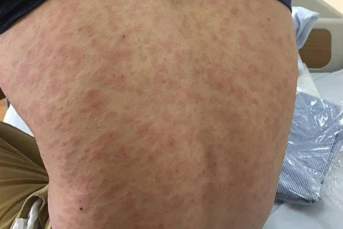 Sau ăn cá thu 30 phút, một phụ nữ phải nhập viện cấp cứu vì sốc phản vệ