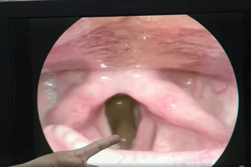 Vặt nắm cỏ đưa vào miệng nhai, người đàn ông ở Hà Nội nhập viện vì có đỉa trong cổ họng