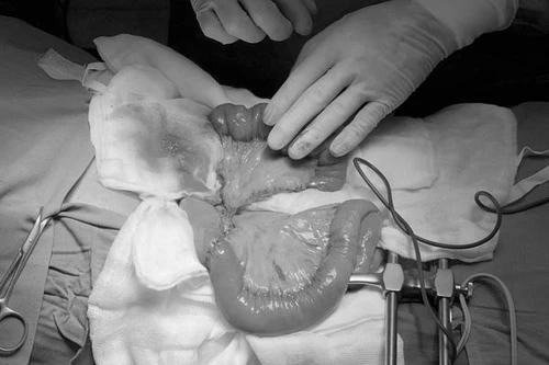 Lần đầu tiên ghép nối ruột tái tạo đường ăn cho người bệnh ung thư họng