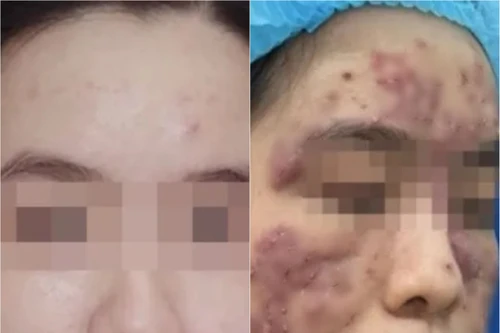 Nhờ bác sĩ kê đơn thuốc online trị trứng cá, cô gái trẻ bị biến dạng gương mặt