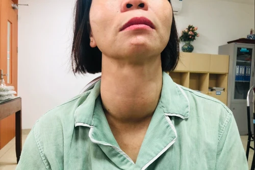Nữ bệnh nhân có khối bướu giáp khổng lồ, hơn 10 năm không điều trị