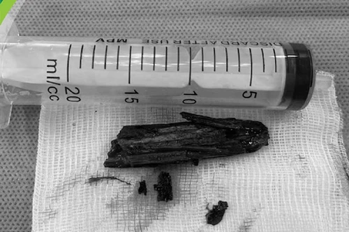 Lấy bỏ đoạn gỗ kèm lá cây kẹt sâu gần khung xương chậu bé trai 6 tuổi