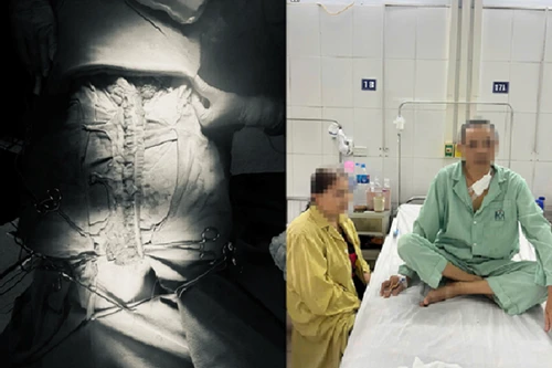 Cắt bỏ toàn bộ ống dạ dày, dùng đoạn đại tràng để tái tạo lại thực quản cho bệnh nhân ung thư