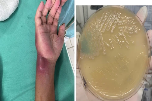 Hai bệnh nhân nhiễm vi khuẩn "ăn thịt người" ở Hòa Bình diễn biến nặng, một ca nguy kịch