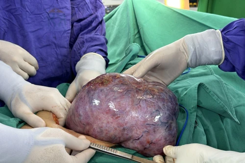 Phát hiện khối u lớn hơn một năm nhưng từ chối phẫu thuật, người phụ nữ nguy kịch