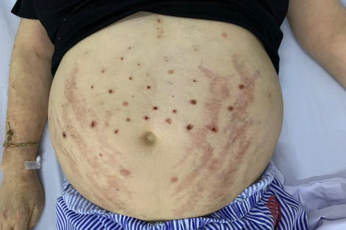 Dùng ong châm để trị giảm đau chân tay, người đàn ông 49 tuổi nhập viện