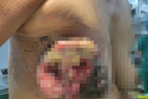 Mắc ung thư vú nhưng từ chối nhập viện để về đắp thuốc nam, nữ bệnh nhân nguy kịch